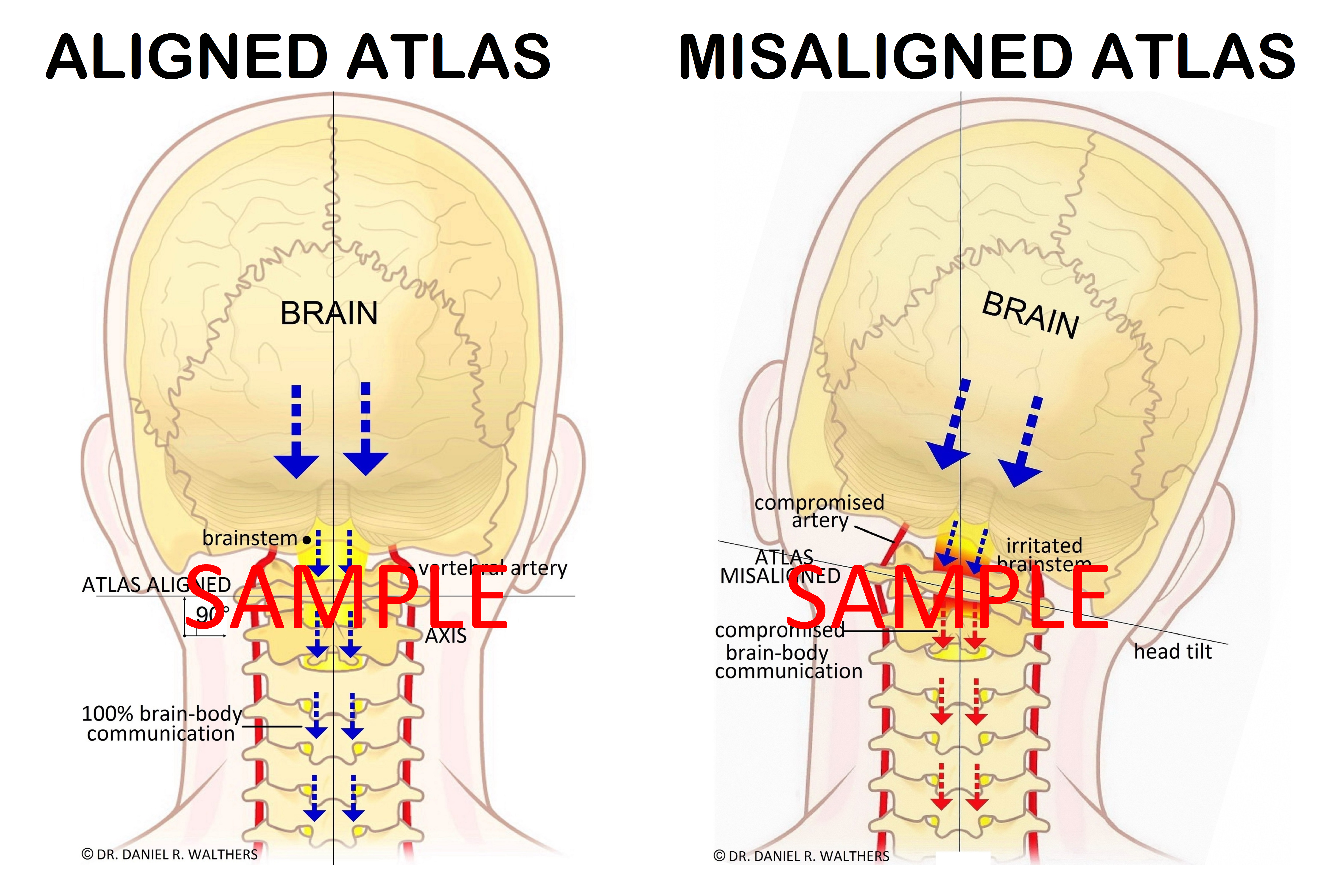 SAMPLE 24X36 Aligned Atlas Misaligned Atlas POSTER