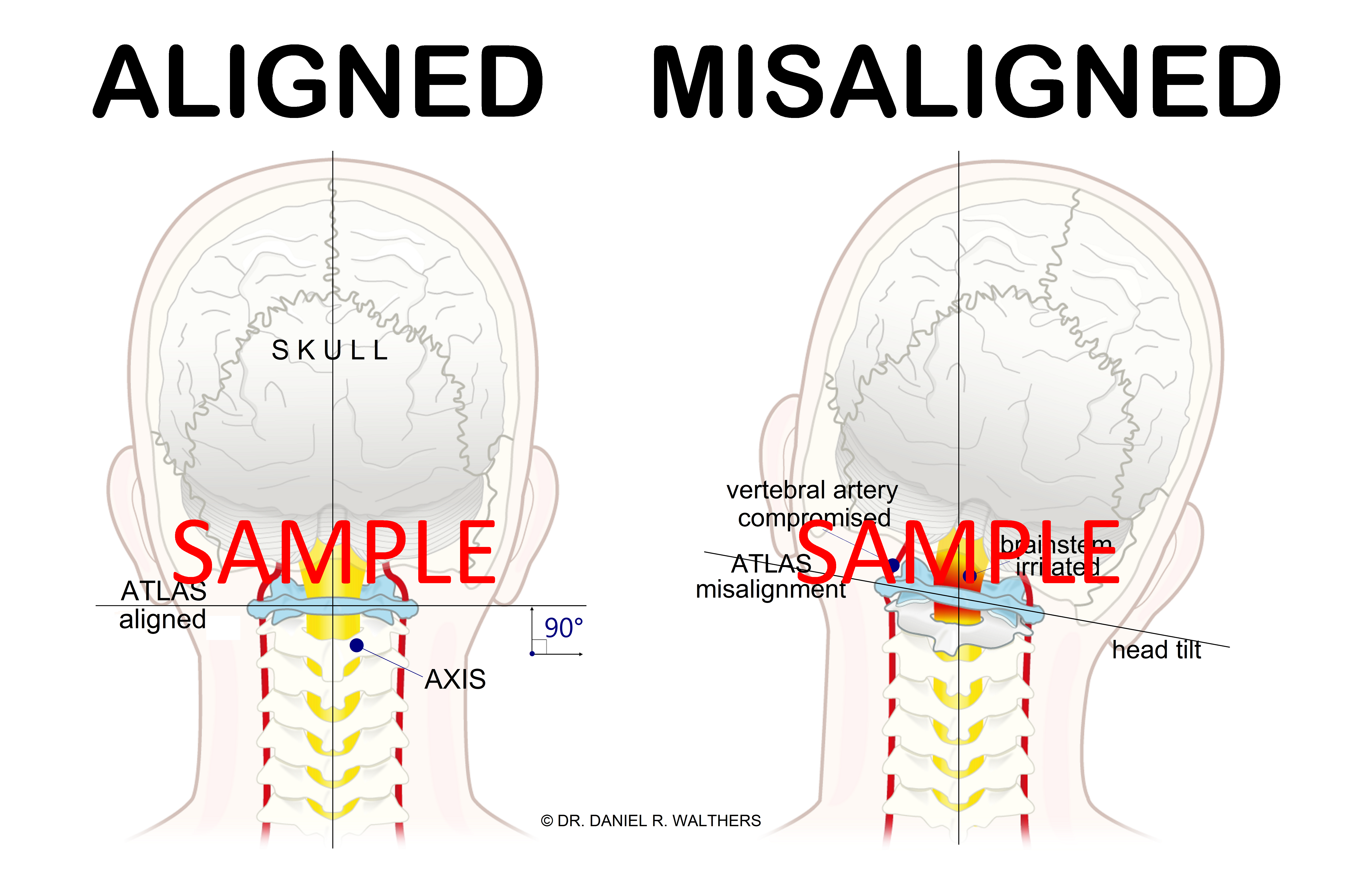 SAMPLE 36 x 24 Aligned Misaligned ATLAS combo POSTER