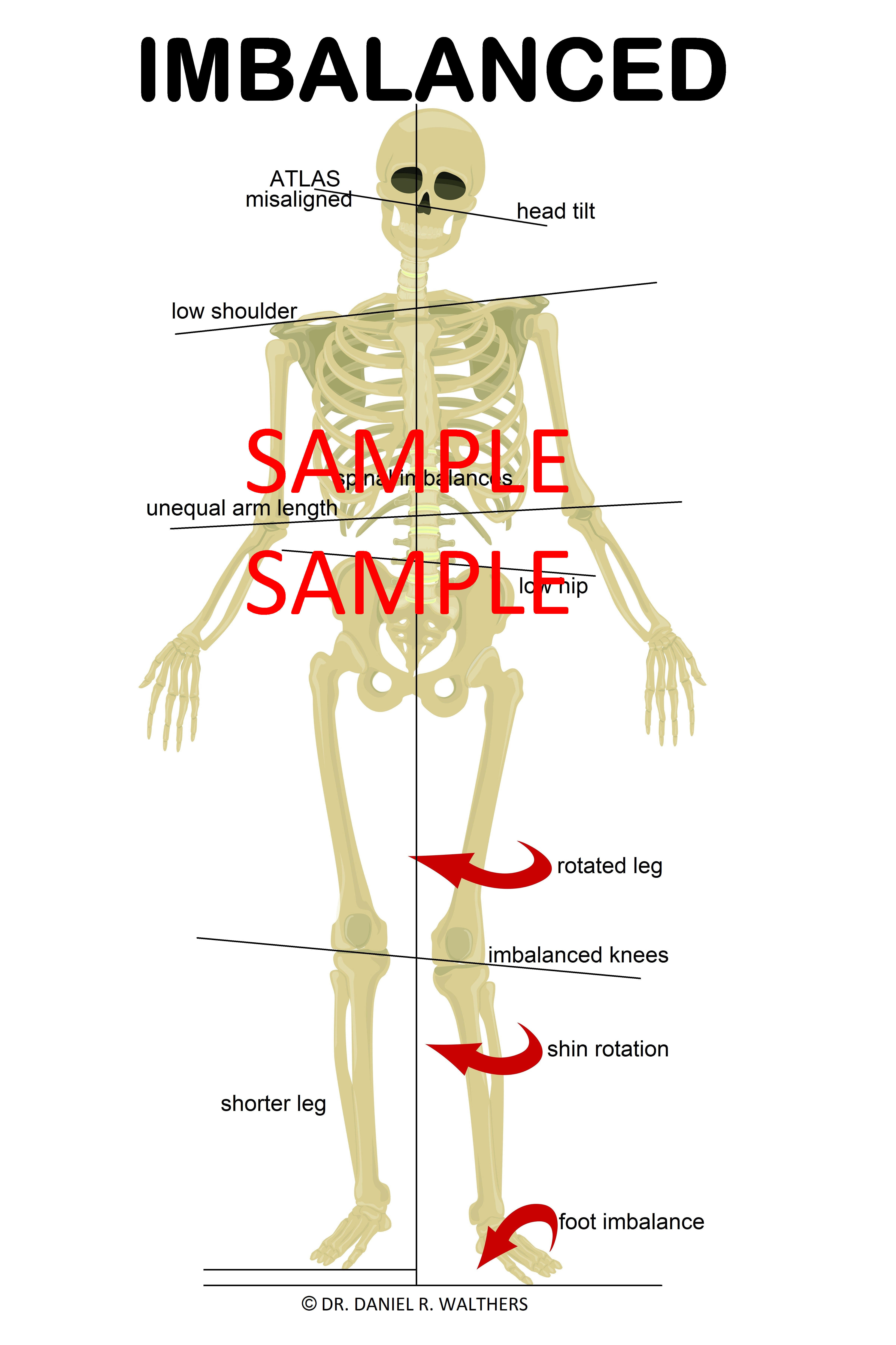 SAMPLE 24X36 GRAY skeleton IMBALANCED POSTER