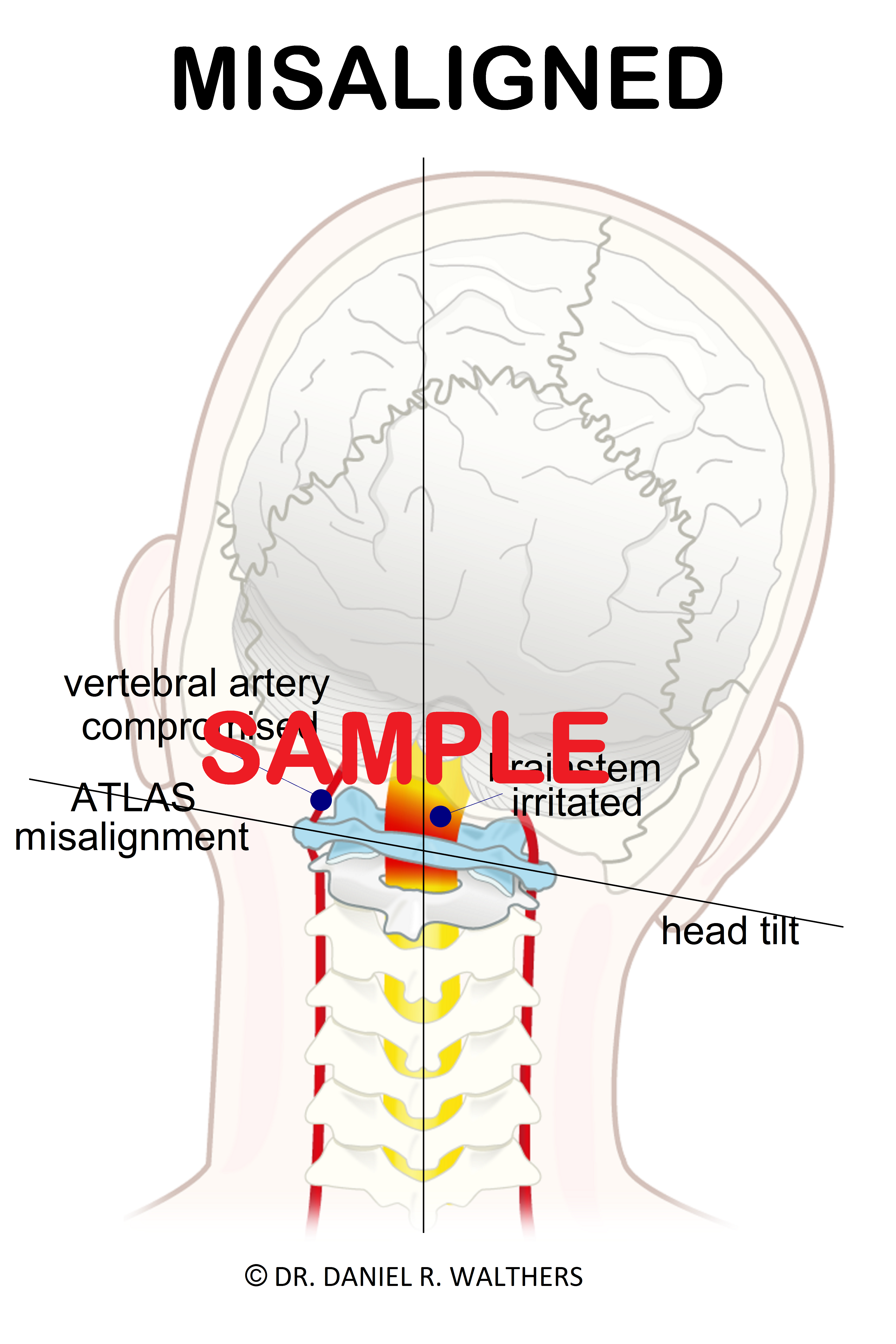SAMPLE 24X36 MISALIGNED ATLAS POSTER